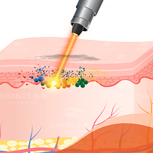 Hút mực bằng Laser 21 Hut mau phun xam bang Laser 01