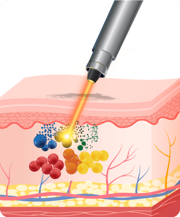 Hut mau phun xam bang Laser 1