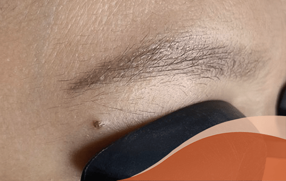 Hút mực bằng Laser 12 lasera2