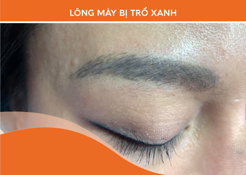 Lông mày bị trổ xanh