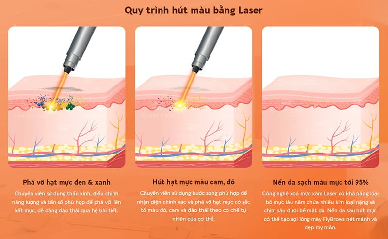 Quy trình hút máu bằng laser xóa điêu khác