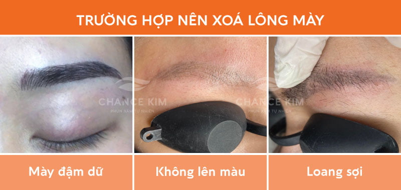 Một số trường hợp điển hình phái đẹp nên thực hiện xoá lông mày