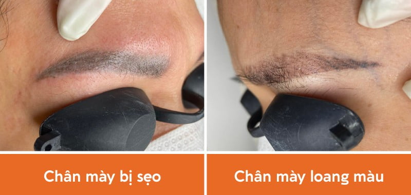 Chân mày bị sẹo, loang màu