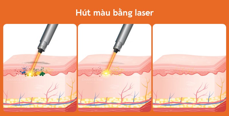 Hút màu bằng lazer