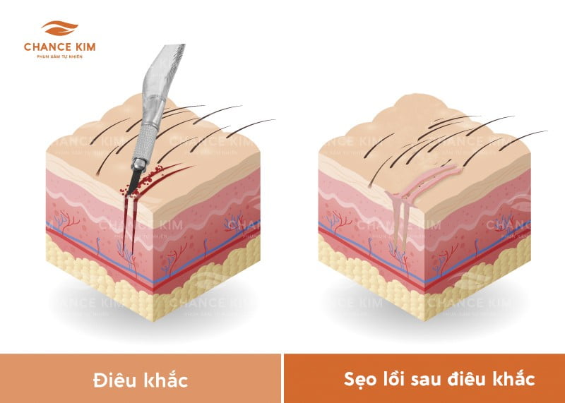 Sẹo lồi điêu khắc