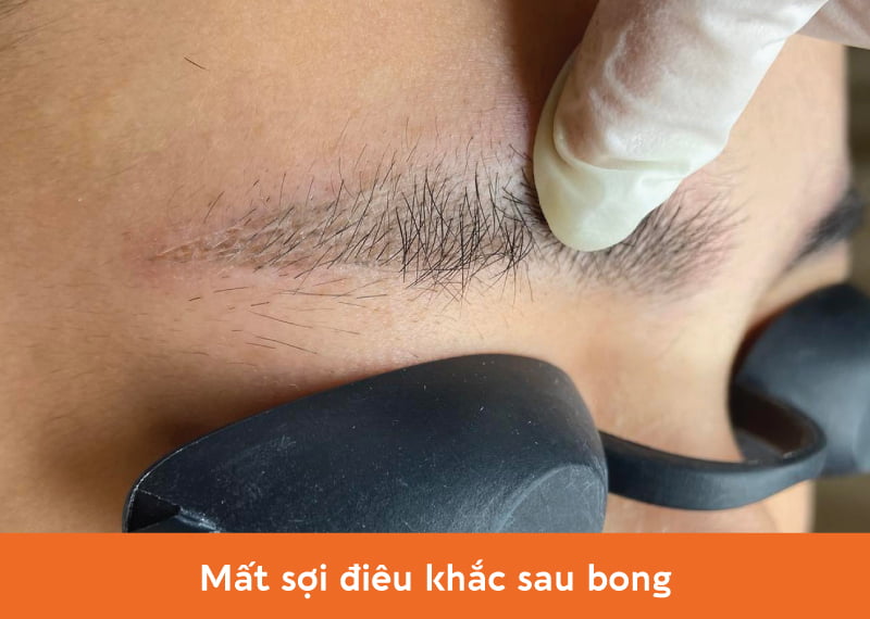 Mất sợi điêu khắc sau bong khiến chân mày bị nham nhở, rời rạc, không đều 