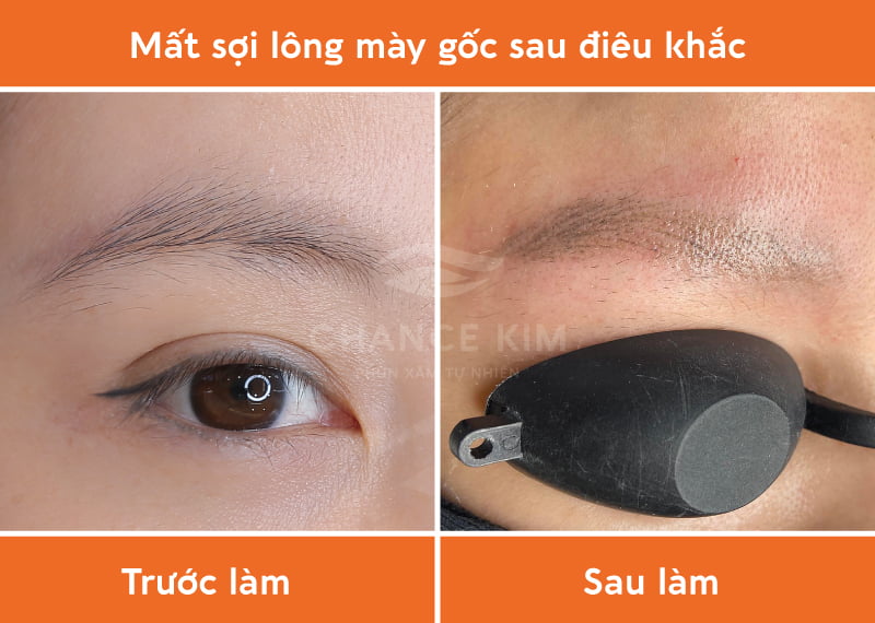 Nhiều người gặp tình trạng sau khi thực hiện điêu khắc bị mất sợi lông mày thật