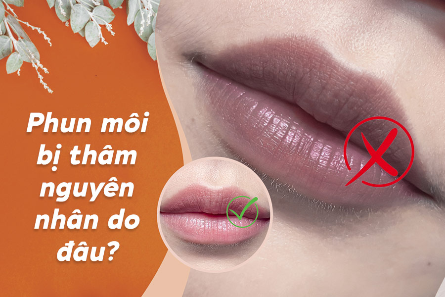 Phun môi bị thâm - Nguyên nhân và Cách xử lý 30 thumb phun moi bi tham