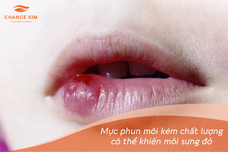 Mực phun môi Collagen kém chất lượng có thể gây tác hại khiến môi mẩn ngứa, sưng đỏ