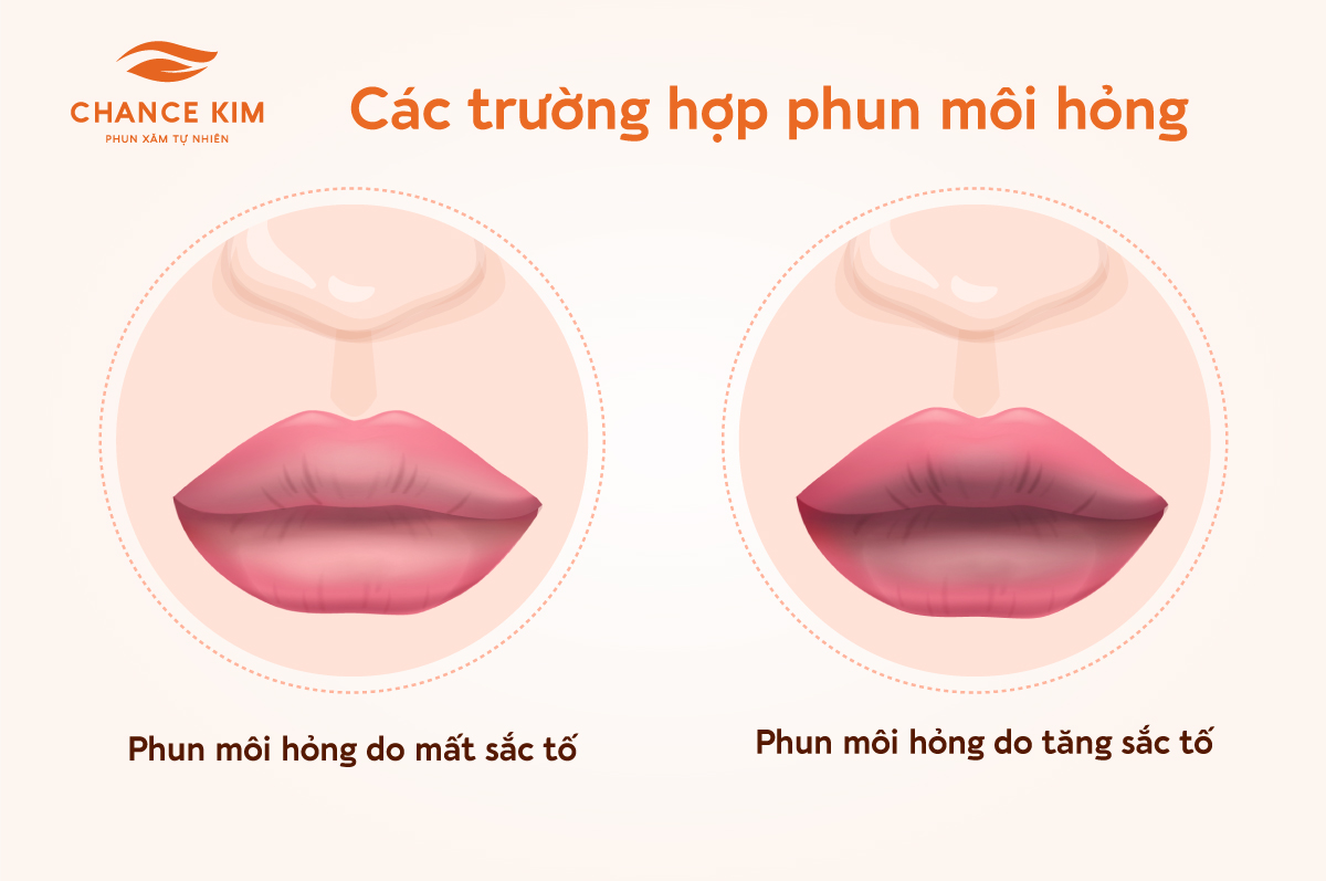 Môi sau phun bị khô nứt phải làm sao? Cách khắc phục