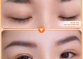 Mực xăm trổ xanh có xóa được không? 7 Sự thật bạn cần biết